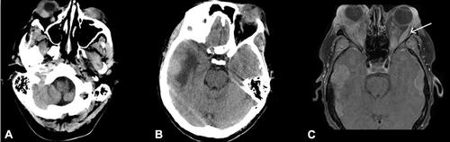 Figure 2 (A, B) Computed tomography showing marked bilateral orbital soft tissue swelling and proptosis, right greater than left, with right retro-bulbar hematoma and/or collection exerting mass effect on the right globe. Bone is intact across both slides cuts. (C) Magnetic resonance imaging demonstrating enhancing intraorbital masses, bilateral proptosis, mass effect, and involvement of extraocular muscles. The left lateral rectus muscle is enlarged (arrow).