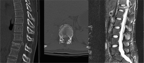 Figure 4. (Above) A patient with a burst fracture (2 points) of T12 following a motor vehicle accident. This patient was neurologically intact (0 points). On imaging, the status of the PLC was indeterminate (2 points). The total TLICS score is 4 points. According to the TLICS system, this injury could be treated nonoperatively or operatively. Nonoperative treatment with a TLSO brace was initially attempted. At her one‐month follow‐up appointment however, the patient was complaing of some lower extremity weakness and urinary incontinence and was noted to have increased kyphosis at the level of the fracture.