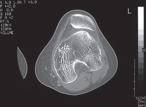 Figure 1. Preoperative computed tomography demonstrating marked trochleodysplasia of the femur, with a sulcus angle of 170°.