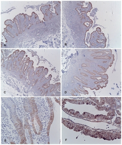 Figure 3 Composite of images of colonic tissue from a patient with ulcerative colitis and adenocarcinoma stained for maspin expression. (A) Non-neoplastic mucosa taken adjacent to the cancer on the proximal side. (B) Non-neoplastic mucosa taken adjacent to the cancer on the distal side. (C) Non-neoplastic mucosa taken 3 cm away from the cancer on the proximal side. (D) Non-neoplastic mucosa taken 9 cm away from the cancer on the distal side. (E) Higher magnification of representative non-neoplastic mucosa taken 3 cm away from the cancer on the distal side; note the predominately cytoplasmic staining of maspin. (F) Note the increased overall expression of maspin in the adenocarcinoma; prominent nuclear staining of maspin is evident.