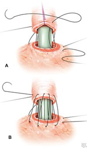 Figure 3 VUA technique with RS. (A) Continuing the suture after placing a transurethral catheter. (B) Anterior anastomotic suture (Image courtesy of ©Stephan Spitzer, medizillu.de; https://www.spitzer-illustration.com/index.php).