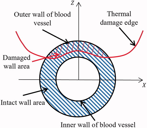 Figure 3. The quantification method of vessel thermal damage.