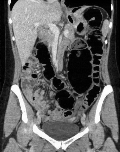 Figure 1. CT abdomen and pelvis. Enlarged, mobile cecum located in the left side of the abdomen. There is gaseous distention of the cecum without obstruction or evidence of rotational torsion/volvulus