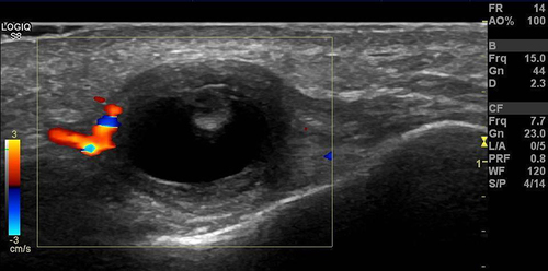 Figure 4 Ultrasound of a 41-year-old man with a lump on his chin shows a subcutaneous cyst with a scolex at the anterior wall. An inflammatory reaction is seen around the cyst. The pathology confirmed the diagnosis of cysticercosis.