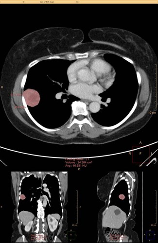 Figure 1 Example PTV measurement using the Philips Intellispace Multi-Modality Tumor Tracking (MMTT) application.