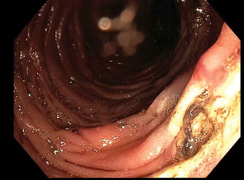 Figure 2. Dieulafoy lesion in the proximal jejunum treated with Argon plasma coagulation.