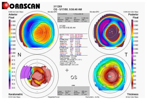 Figure 4 Three-year postoperative topographic corneal map of a patient (DPL) from group 1.