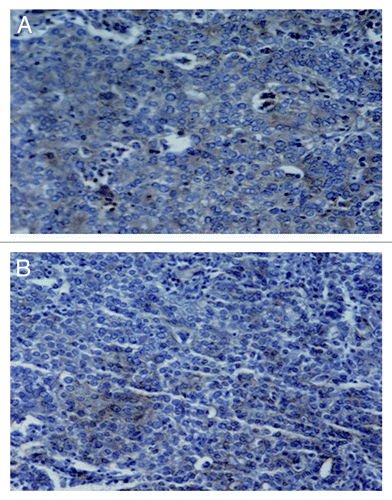 Figure 4. Immunohistochemistry staining of MMP-2 in prostate cancer tissues. (A) A widespread signal of MMP-2 (brown staining) in the cytoplasm of VM-positive prostate cancer tissues. (B) A weak signal of MMP-2 in the cytoplasm of VM-negative PCa tissues. Original magnification: × 200.