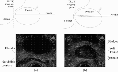 Figure 2. The observed prostate shift during needle insertion.