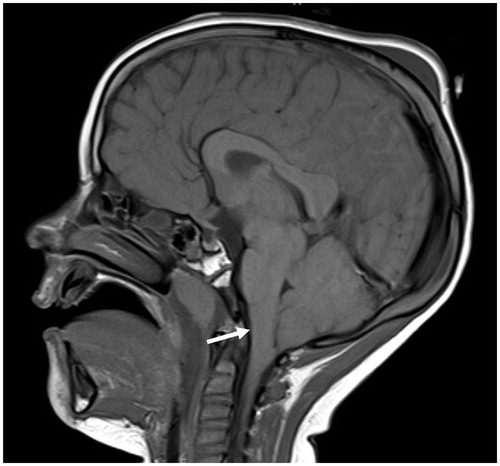 Figure 1. Pre-operative sagittal T1-weighted MRI showing severe sagging of the brainstem and cerebellum (white arrow) from low CSF volume state in setting of a Chiari malformation.