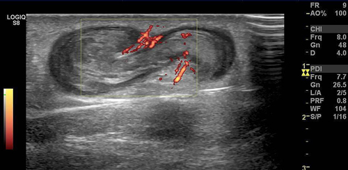 Figure 6 Doppler ultrasound of a 55-year-old man with superficial thrombophlebitis caused by a spider bite shows an intraluminal thrombus in the dilated lumen and thickened wall of the great saphenous vein of the left leg.
