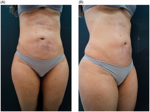 Figure 5. (A,B) One month after treatment.