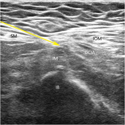 Figure 3 Sonoanatomy of FICB. Arrow, needle pathway.