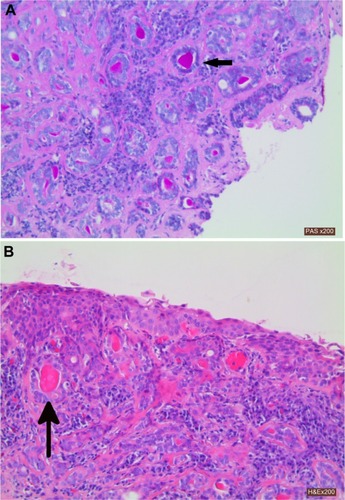 Figure 1 (A) PAS diastase stain (×200) of the lesion confirming pink mucin within numerous ductal structures (arrow). (B) H&E stain (×200) of the lesion showing a predominantly well differentiated population of tubular ductal structures (arrow) and occasional squamoid cords extending beneath the conjunctival surface in mildly fibrotic stroma.