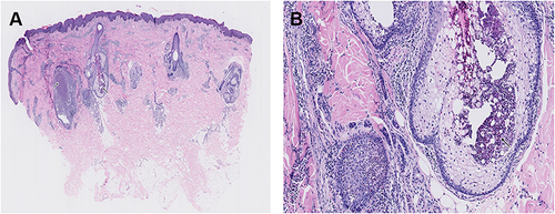 Figure 2 Histopathological findings. (A and B) the epidermis was normal and the dermal follicular sebaceous gland unit was infiltrated by a large number of neutrophils and eosinophils (black arrows), forming eosinophilic microabscesses.