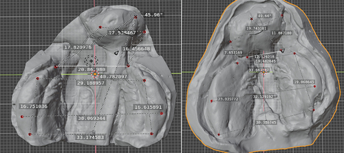 Figure 4. Maxillary dimensional analysis before (left) and after (right) nasoalveolar moulding therapy.