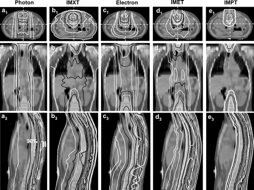 Figure 1. Dose distributions for Patient 2, showing the conventional photon (a1–a3), IMXT (b1–b3), conventional electron (c1–c3), IMET (d1–d3), IMPT (e1–e3) plan in a transverse (a1–e1), sagittal (a2–e2), and coronal (a3–e3) sections. The PTV and CTV are delineated with the dark dotted lines. Isodoses are, in percentage, 5%, 10%, 30%, 50%, 70%, 90%, and 100%. Isodose lines of 50% and 90% are in solid black lines, others are in white.