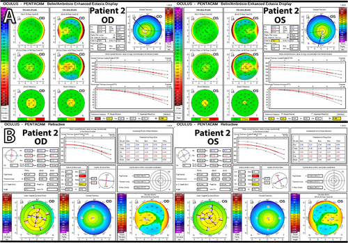 Figure 4 (A) Pentacam enhanced ectasia display maps suggestive of central thinning. (B) Pentacam refractive maps.