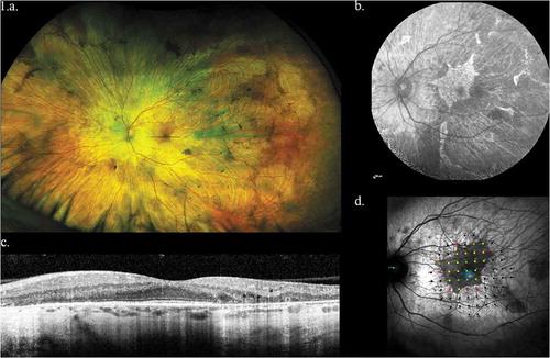 Figure 1. Representative left eye images of 32 year old male with CHM mutation. (a) Widefield optos color image showing baring of sclera and peripheral pigmentation. (b) Macular fundus autofluorescence showing the central area of relative RPE preservation. (c) OCT image showing loss of outer retina with central island of preservation. (d) Microperimetry data showing central preservation of retinal sensitivity with sharply demarcated sensitivity drop-off corresponding to island of surviving RPE