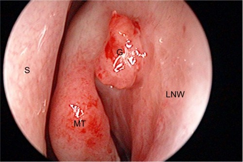 Figure 1 Excessive granulation formation over the hinostomy site.