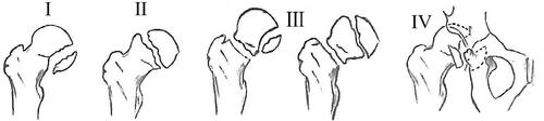 Figure 1 Pipkin classification of femoral head fractures. Type I: Fracture below fovea, Type II: Fracture above fovea, Type III: Type I or II with an associated femoral neck fracture, and Type IV: Type I or II with associated acetabular fracture.