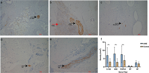 Figure 1 Nerve fibers in abdominal wall endometriotic lesions stained with S-100 (a), NSE (b), PGP9.5 (c), SP (d) and NF (e). Black arrows denote tiny positive multiple nerve fibers. The red arrow denotes neuroendocrine cells stained for NSE in ectopic endometrium. Magnification ×100 for all photomicrographs. (f) Nerve fiber density in AWE lesions and control scars.