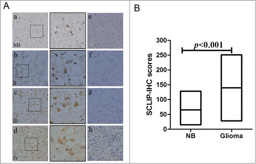Figure 2. Immunostaining of normal brain and glioma sections with SCLIP antibody. (A) Immunohischemistry showed that SCLIP was weakly localized in most human normal brain cells (a, NB). SCLIP expression was evidently detected in primary glioma cells grades II(b) and strongly observed in glioma samples grade III (c) and IV (d). The SCLIP-positive cells were magnified to show their histological appearance (black box). Negative control of normal brain and gliomas samples (e, f, g and h) has the same incubation conditions as the tested group except that the primary antibody was omitted. Sections were counterstained with hematoxylin (blue). Scale bar = 25 μm. (B) Average number of SCLIP-positive cells was significantly higher in glioma samples (gliomas) than control normal brain tissue (NB). The expression scores of SCLIP implement expression intensity and percentages of positive cells (score=staining intensity×% positive cells).