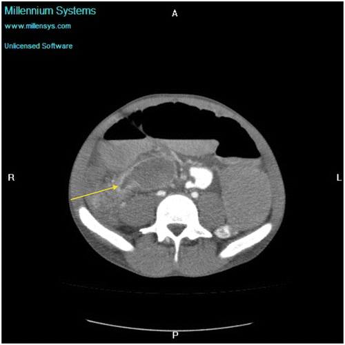 Figure 9a: Axial CT enterography using water showing gross SBO with an abrupt transition point (arrow) in the right iliac fossa secondary to a stricture from tuberculosis