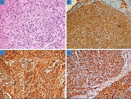 Figure 2. (a) Histomorphological appearance of the smooth muscle tumour of uncertain malignant potential (STUMP) (H&E, 200×). (b) Moderate expression of AQP3 in STUMP tissue (Immunoperoxidase, 200×). (c) Strong expression of AQP7 in STUMP tissue (Immunoperoxidase, 200×). (d) Strong expression of AQP9 in STUMP tissue (Immunoperoxidase, 200×).