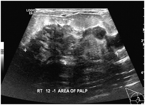 Figure 1. US right breast revealing diffuse multifocal hypoechoic branching masses occupying its upper half measuring 4.3 × 1 cm at the upper outer quadrant, 6.3 × 2.4 cm centrally located at 12 o’clock position extending to upper internal quadrant and 3.5 × 1.2 cm at 3 o’clock.