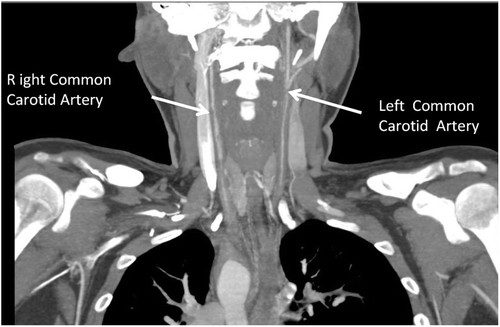 FIGURE 4  CT scan showing stenosis of common carotid arteries bilaterally.