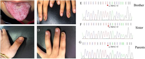 Figure 1. Clinical features and AIRE mutations in two Chinese patients with chronic mucocutaneous candidiasis. A-B. Thrush and fingernail changes of the brother. C-D. Fingernail involvement of the sister causes shedding of the nail plate and oozing scabs of the nail bed. E-F. DNA sequencing chromatograms demonstrate homozygous AIRE mutation in exon6: c769 C > T, p. Arg257Ter in the brother and sister. G. The heterozygous carriers of the variant in exon6: c769 C > T of their parents.