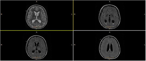 Figure 1. MRI showing diffuse leptomeningeal enhancement.