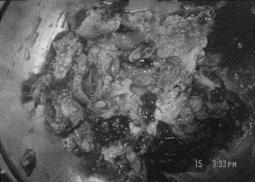 Figure 1.  Primary peritoneal carcinosarcoma/ MMMT excised from the pelvic cavity. More than a hundred pieces of tumorous tissue measuring up to 5.3 x 4.1 x 3.5 cm in size and 223 g in weight was submitted for pathologic study. They were yellow to white in color and soft in consistency, with hemorrhage and necrosis.