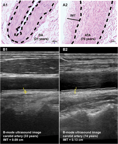 Figure 1 IMT in young and old arteries. The hematoxylin-eosin staining of tissue sections from digital artery (DA, 21-year old, (A1)) and anterior tibial artery (ATA, 70-year old, (A2)). Tissues were obtained from male patients who had radical surgeries for polydactyly and malignant melanoma of lower extremity, respectively, sectioned at 4 micrometers, and fixed with 4% polyformaldehyde for 24 hour prior to staining. The IMT was only measured and pointed in ATA and the tunica media layers were labeled with dash lines as IMT was too thin to be measured accurately. (B1 and B2) are B-mode ultrasound images of carotid arteries from two male patients at the ages of 33 (IMT = 0.09 cm) and 74 year (IMT = 0.13 cm). The intimal-medial layers were labeled with dash lines. The positions for measuring IMT were pointed with yellow crosses.