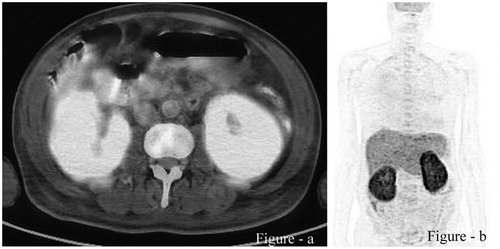Figure 1. (a, b) FDG-PET-CT images depicting diffuse FDG accumulation in both kidneys with a SUVmax of 13.80.