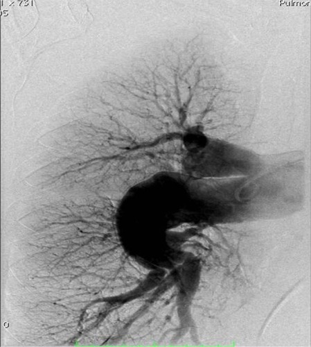 Figure 9 Right sided pulmonary artery angiography performed at Giessen indicating chronic thromboembolic pulmonary hypertension which was also demonstrated by two ventilation/perfusion (V/Q) mismatches.