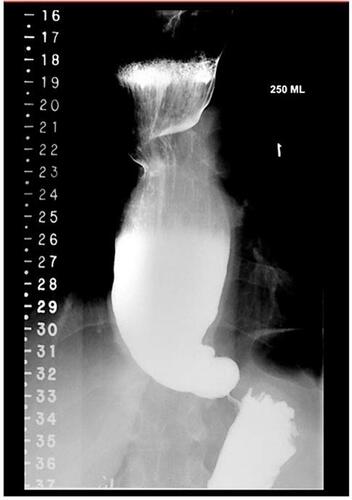 Figure 2 Dilated esophagus with retained barium and tapered bird beak appearance at GEJ.