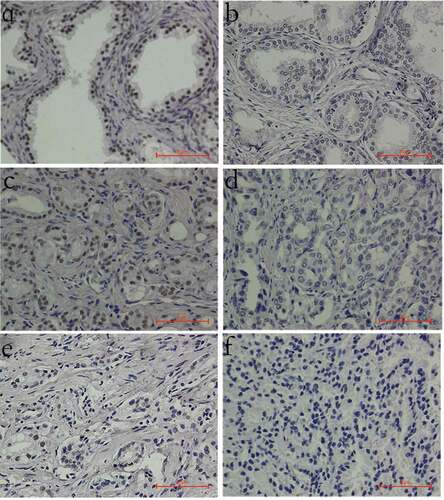 Figure 1. INTS6 protein staining patterns in prostate tissues (magnification, 400×). (a) Positive INTS6 staining in the nucleus of most benign prostate tissues. (b) Decreased INTS6 staining in a benign prostate tissue sample. (c) Positive INTS6 staining in a prostate cancer tissue sample. (d, e) Decreased staining intensity or a decreased proportion of positive nuclei in prostate cancer tissue. (f) Negative INTS6 staining in a prostate cancer tissue sample