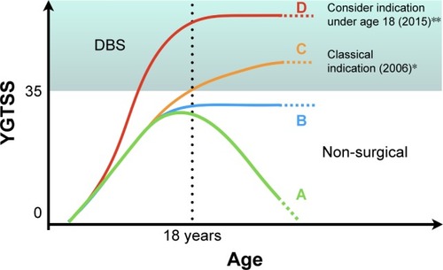 Figure 1 Diagram showing some of the possible clinical evolution that can be interpreted as natural history of TS or outcome from non-surgical therapeutic interventions based on YGTSS as a severity measure. This diagram intends to illustrate the current indications for DBS according to earlier and latest criteria. (A) Clinical resolution of TS symptoms. (B) Presence of tics that do not resolve spontaneously or are kept stable under non-surgical treatments. (C) Classical indication for DBS based on the severity of disease and age (18 years). (D) Latest proposed indication for DBS based on severity as a determinant factor even before 18 years of age.