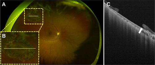 Figure 2 A multimodal imaging of a 74-year-old female with a peripheral retinal hole treated by a laser photocoagulation in the right eye. (A) An ultra-widefield fundus photograph. A retinal hole surrounded by laser scars is observed in the mid-peripheral area (yellow-dotted square). (B) A magnified image of the yellow-dotted square on (A). (C) An ultra-widefield swept-source optical coherence tomography image of the yellow line (A and B). The edge of the retinal hole is slightly detached (white arrow).