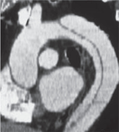 Figure 4 Computer tomography with enhanced contrast showing type B dissection.