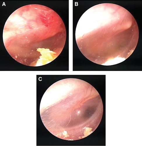 Figure 1. Changes in the otoscopic findings of a patient with acute otitis media. (A) At the initiation of acute treatment (amoxicillin, AMPC); score = 16. (B) At the initiation of additional treatment (S-CMC + CAM); score = 12 (after 7 days). (C) At the completion of additional treatment; score = 0 (after 14 days).