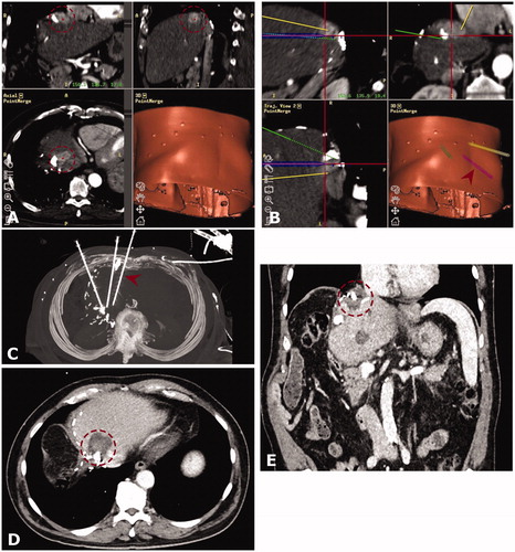 Figure 3. Case of a 75-year old male with a 4 cm hepatocellular carcinoma (HCC) between the heart, remaining left hepatic vein and inferior vena cava. Note the lipiodol deposition indicating a prior transcatheter arterial chemoembolization (TACE) and the surgical clips indicating a prior extended right hemihepatectomy. (A and B) Arterial phase CT mages from the navigation system in three planes (A, HCC marked by red dashed circle) and images of the 3-dimensional needle path planning (B). The red arrowhead shows the position of a placed co-axial needle. (C) Maximum intensity projection (MIP) of control CT with three coaxial needles in place. The needle from image (B) is marked by a red arrowhead. (D and E) Follow-up CT after 6 months (D) and 24 months. (E) showing no evidence of local tumor recurrence (red dashed circle is marking the coagulation zone).