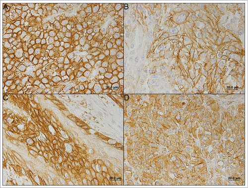 Figure 1. Immunohistochemical expression of MCT1 (A), MCT4 (B), GLUT1 (C) and CAIX (D) in melanoma. All the proteins were more importantly found in the plasma membrane of cells. (A) Stage IIC primary tumor; (B) Stage IIB primary tumor; (C) Distant metastasis; (D) Stage IV primary tumor.