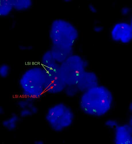 Figure 7 Interphase BCR/ABL1 FISH analysis showing 2 green (22q11.2) and 2 red (9q34) signals in cells. Record according to ISCN 2016 - nuc ish(ABL1,BCR)x2. Analysis was performed on 3–4 µm formalin-fixed and paraffin-embedded (FFPE) lymph node sections using the commercial BCR/ABL1 DCDF probe from Vysis. The areas analyzed were identified and marked by a pathologist. Slides were then dewaxed using the Paraffin Pretreatment Reagent Kit (Vysis, Abbott) and subjected to overnight hybridization with a molecular probe according to the manufacturer’s protocol (Vysis, Abbott).