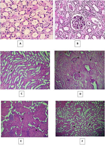 Figure 7. Histopathological changes in (300 mg/kg) dose vancomycin-induced renal injury in rats (Hematoxylin and eosin ×40). (A and B: control group). (A): normal renal tubules, (B): normal glomerulus; (C, D, E and F: vancomycin group). (C) abnormal dilatation of the renal tubules and vacuolization and necrosis of the epithelium of renal tubules, (D) complete glomerular injury and complete hyaline dystrophy, (E) Showing renal tubules filled with leukocytes, and (F) medullary vascular congestion.