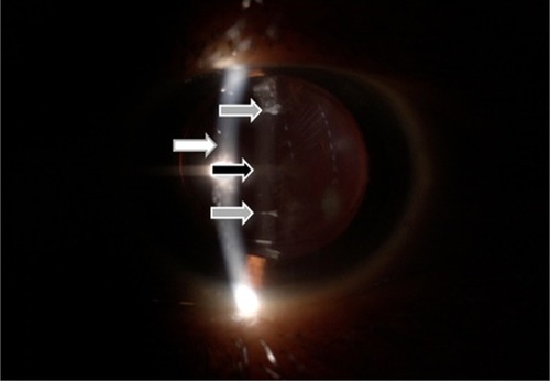 Figure 3 Anterior segment photography of the right eye after Nd:YAG capsulotomy.