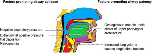 Figure 1. The interplay of forces on the upper pharyngeal airway. Inspiratory negative pressure and extraluminal positive pressure tend to promote pharyngeal collapse while upper airway dilator muscles and increased lung volume tend to maintain pharyngeal patency (Image by authors).
