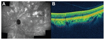 Figure 4 (A) Infrared montage of left eye showing residual choroidal lesions in the posterior pole after 3 years of follow-ups (black line corresponds to the optical coherence tomography [OCT] cut and red circles highlight the choroidal infiltrates circled on OCT scan); (B) OCT scans revealing a focal increased reflectivity at the level of sub-retinal pigmented epithelium–choriocapillaris complex (red circle) confirming the presence of the lesions indicated on infrared montage (see Figure 4(A)).